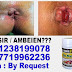 Jual Obat Wasir Ambeien Paling Ampuh