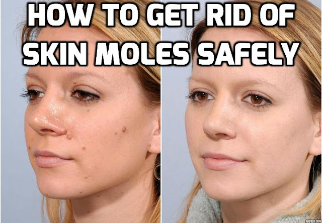 Skin moles are skin growths that may have a variety of colors, shapes and sizes. Although some may be regarded as beauty marks, many others are quite unsightly which is why many people are looking for ways to remove skin moles.