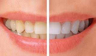Teeth Whitening Citrus Heights