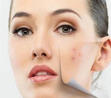 How To Get Rid Of Acne, Acne Treatment, Acne Scars, Home Remedies For Acne, Home Remedies For Pimples, Acne Home Remedies, How To Remove Acne Scars, What Causes Acne, What Is Acne, Beauty Tips, Severe Acne, Cure Acne, Acne Causes