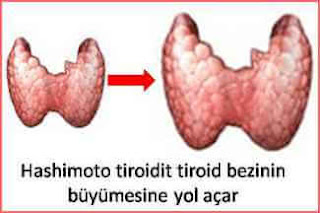 Hashimoto tiroidit belirtileri