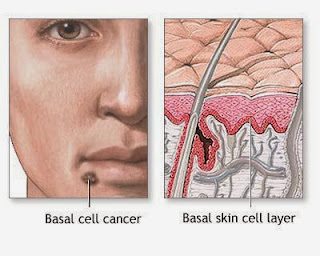 Types Of Most Common Cancer,Early Skin Cancer,Primary Liver Cancer,Most Common Cancer Types