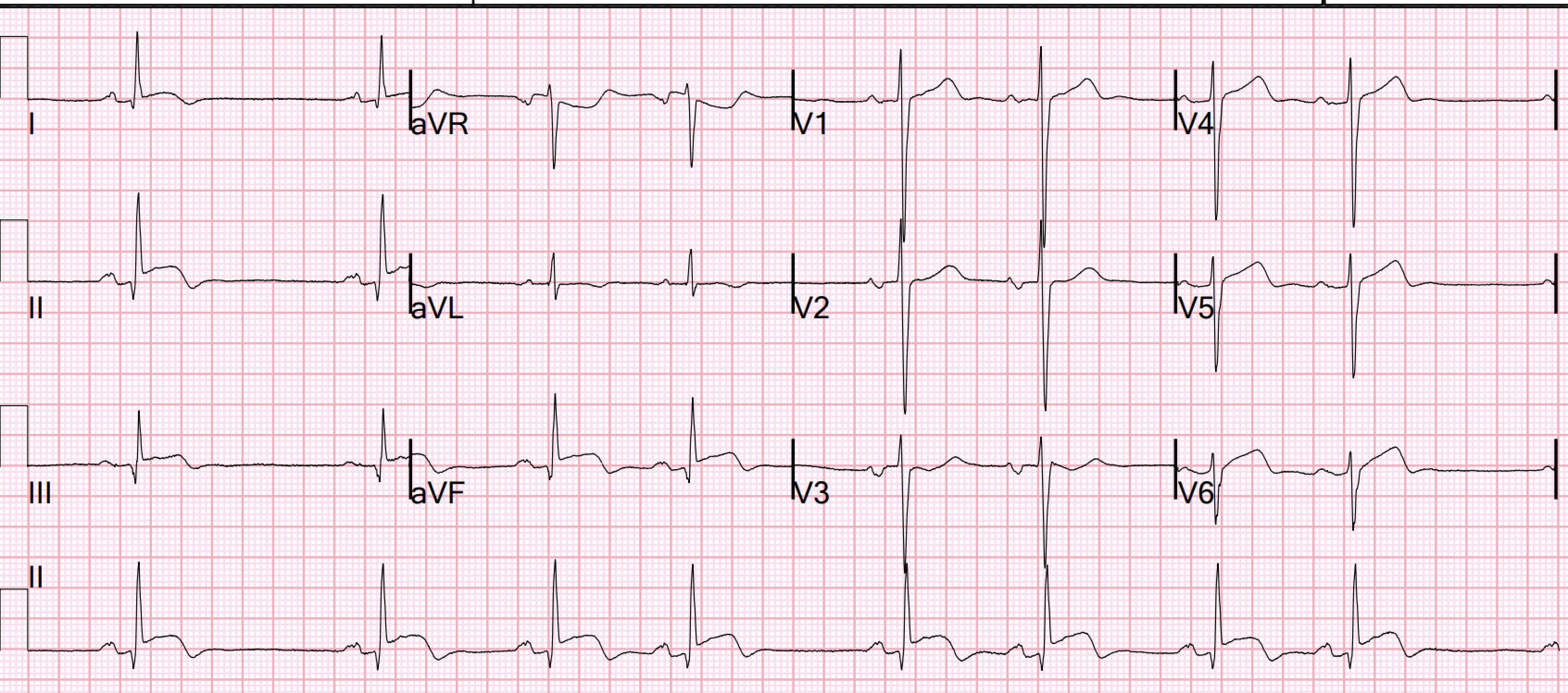 Qrs на экг что это. ECG km 122. Комплекс QRS типа QS. Abnormal QRS. Неправильной формы QRS.