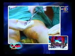 TonightShow Surgery ศัลยกรรมน่อง เกาหลี