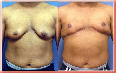 gynecomastia