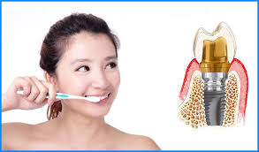 Cấy ghép implant có thể ngăn ngừa được tình trạng tiêu xương hàm ở những vị trí răng đã mất