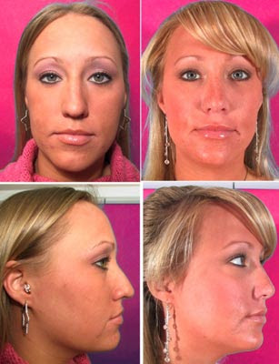 Rhinoplasty Before After