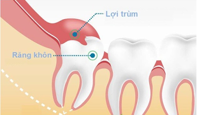 Thời gian mọc răng khôn bao lâu?