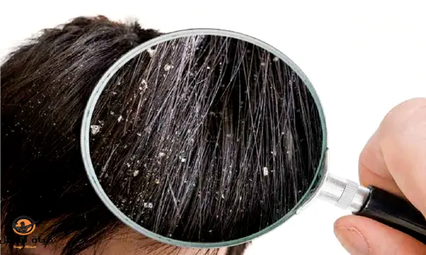 علاج قشرة الشعر وبعض النصائح للتخلص منها