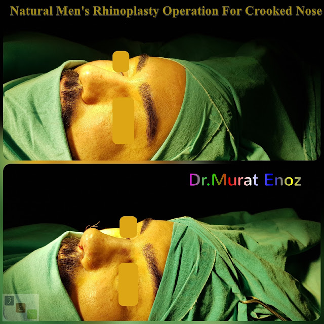 Natural Men's Rhinoplasty Operation For Crooked Nose - Nose Job For Men Istanbul