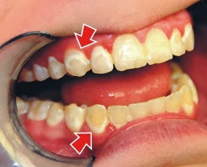 Eternity is Forever: Things You Need to Know Before Getting Braces