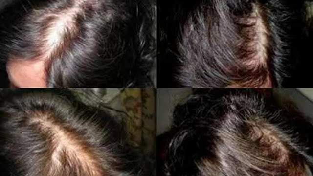 obat rambut rontok alami