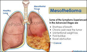 Mesothelioma lawyer  FIRE SAFETY AND HEALTH