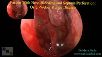 osler weber rendu, hereditary hemorrhagic telangiectasia, epistaxis, septum perforation, epistaxis, endonasal cauterization, genetic vascular disease, nasal lesions, AV malformations, telangiectasia