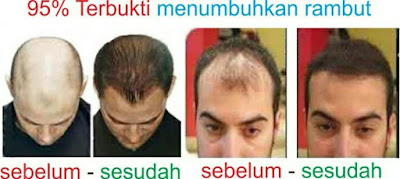 https://penghapustattoalami.blogspot.com/2019/02/cara-cepat-mengatasi-rambut.html