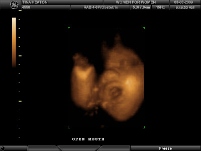 3d ultrasound 20 weeks boy. It#39;s still a oy. Yeah!