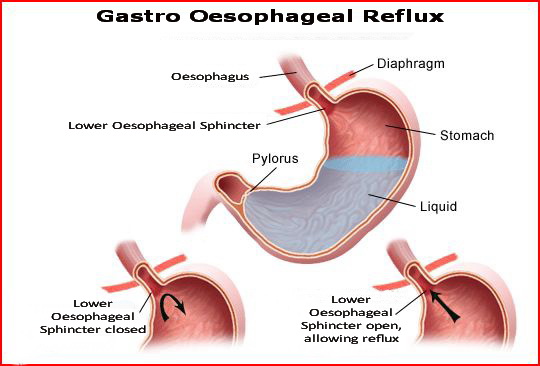 reflux laryngopharyngeal reflux disease lpr than the stomach acid 