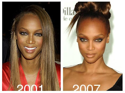 Tyra Banks Plastic Surgery