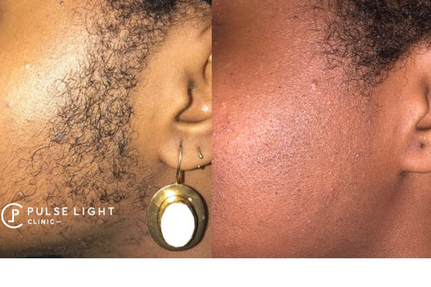 Polycystic Ovary Syndrome Electrolysis: The Ultimate Solution for Long-lasting Hair Removal