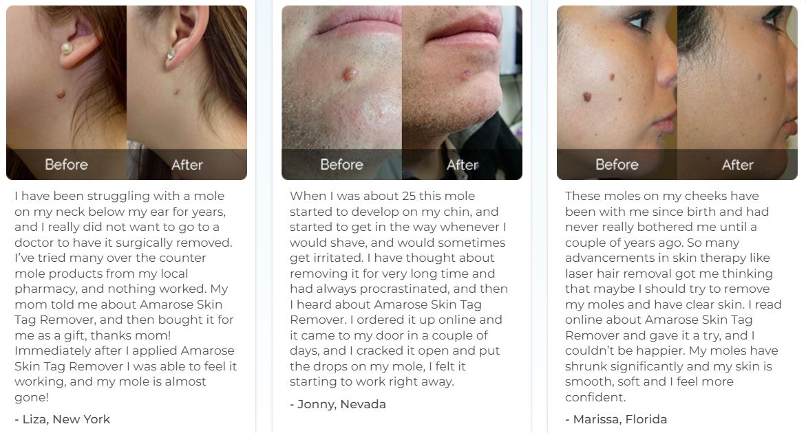 Amarose Skin Tag Reviews