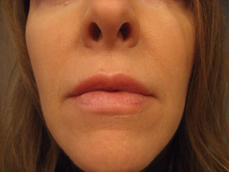 3rd TCA Chemical Peel - Before 2011