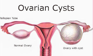 Cara cepat kecutkan Cyst tanpa pembedahan, ovarian cyst, normal ovari, ovari punca wanita tak boleh mengandung, hormal tak stabil, kitaran period tak betul, tak datang period, ketumbuhan dalam rahim, gla complex shaklee kecutkan Cyst, rawatan semulajadi Cyst,