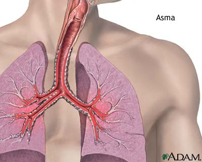 penyakit asma