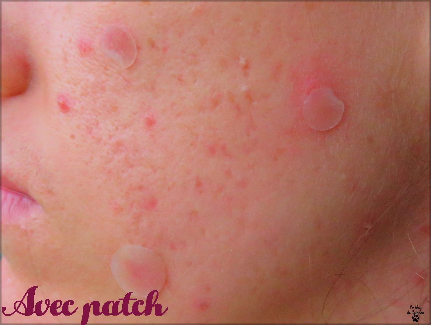 Skin Essentials - Spot Patch - Alvira - Action