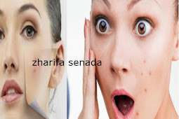 17 how to get rid of acne naturally, effectively and without side effects for women and men