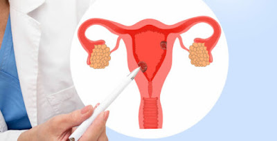 Signs of Uterine Cancer