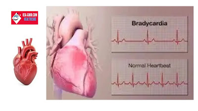What is bradycardia?