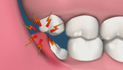 Biểu hiện của lợi trùm răng khôn