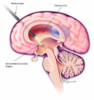 Brain Biopsy2