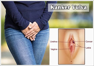 Kanker Vulva