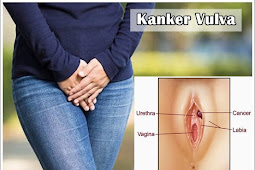 Kanker Vulva