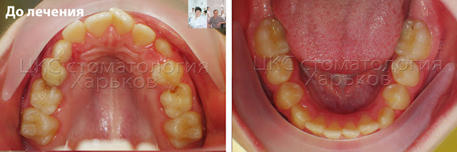 Форма зубных рядов пациента до лечения