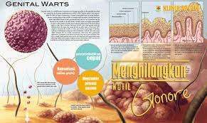 Mengenal Gejala Kutil Kelamin/ Kondiloma akumuinata