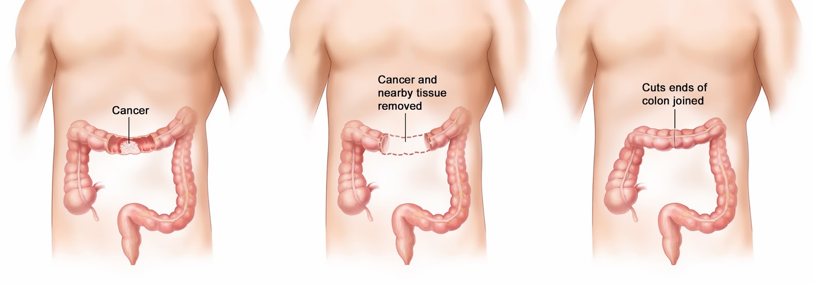  Cancer surgery cost in India | best cancer treatment India