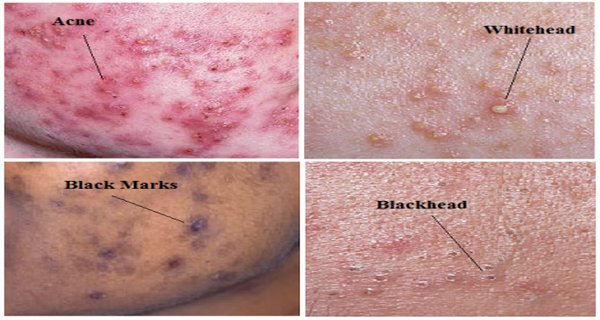 How To Remove Acne, Pimples And Black Marks Naturally (2 Ingredients 