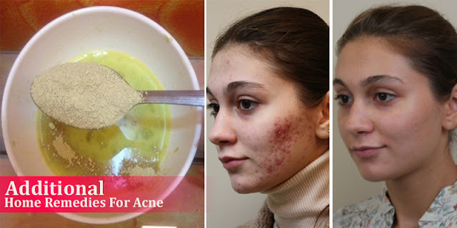 Additional Home Remedies For Acne - How To Remove Acne Naturally