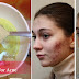 Additional Home Remedies For Acne - How To Remove Acne Naturally