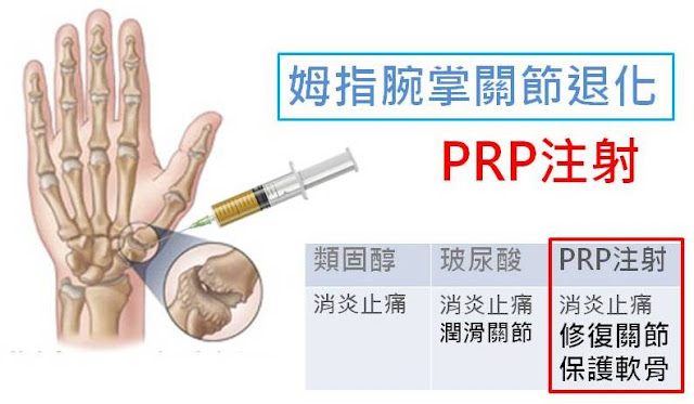 #大拇指痛治療 #大拇指關節痛 #拇指腕掌關節炎 #拇指腕掌關節退化 #基底關節炎 #大拇指關節痛滑手機 #PRP #李嘉瑋醫師