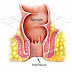 6 Tips Rawatan Anal fissur ( Anal fissure )