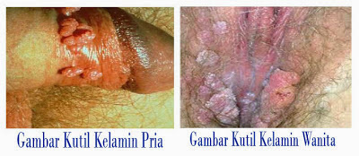 Jamur Kutil Kelamin Parah