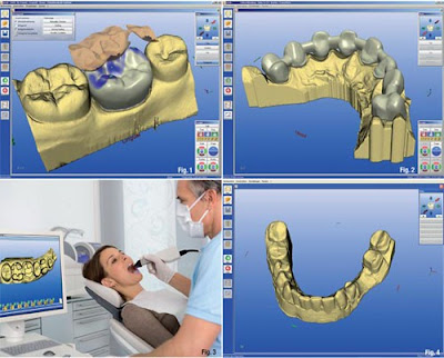Trồng răng implant là gì ?