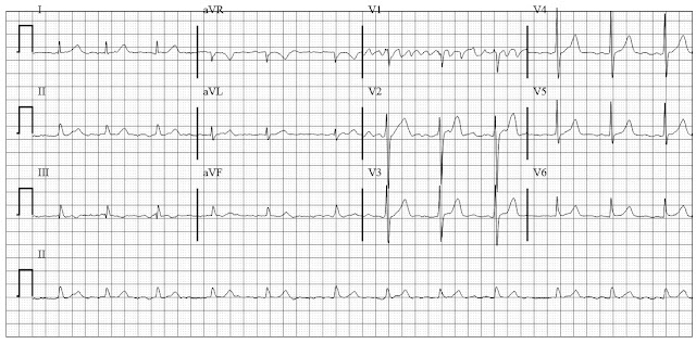 ECG