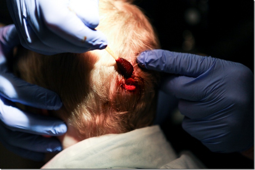 Alex gets 4 staples in the back of his head (8)-small