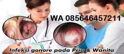 Obat Herbal Buat Penderita Gonore Menahun