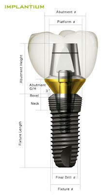 Cấy ghép Implant an toàn chi phí hợp lý