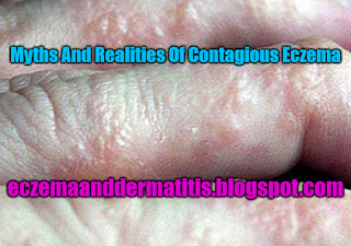 Myths And Realities Of Contagious Eczema